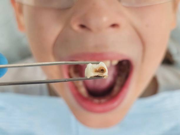Best Emergency Tooth Extraction  in Racend, LA